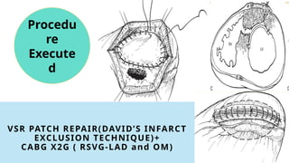 VSR PATCH REPAIR(DAVID’S INFARCT
EXCLUSION TECHNIQUE)+
CABG X2G ( RSVG-LAD and OM)
Procedu
re
Execute
d
 