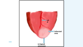 LA
D
LV Apical
aneurysm
Infarcted
area
 