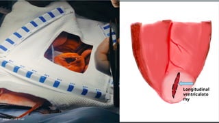 Longitudinal
ventriculoto
my
 