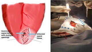 Infarcted
septal
tissue
Ventricular
septal defect
with multiple
openings
 