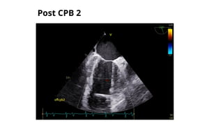 Post CPB 2
 