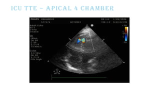 ICU TTE – APICAL 4 CHAMBER
 