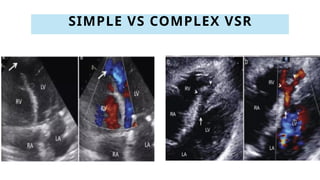 SIMPLE VS COMPLEX VSR
 