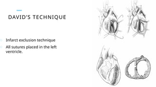 DAVID’S TECHNIQUE
o Infarct exclusion technique
o All sutures placed in the left
ventricle.
 