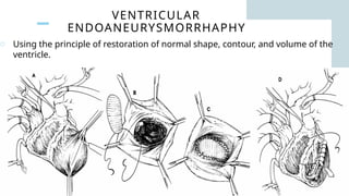 VENTRICULAR
ENDOANEURYSMORRHAPHY
o Using the principle of restoration of normal shape, contour, and volume of the
ventricle.
 