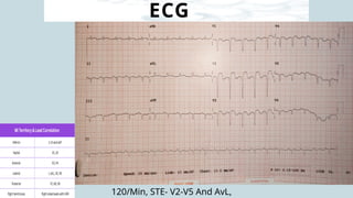 ECG
120/Min, STE- V2-V5 And AvL,
 