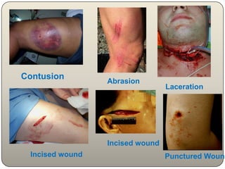 Extractions