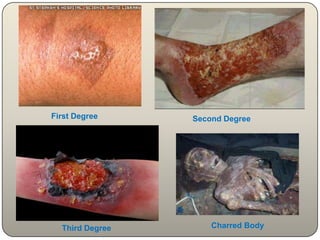External Examination of Hands & other partsHands: For hair, cloth, mud, blood or weapon graspedScraping from under the nails takenGenitalia, breasts Condition of the body: Stout or Emaciated? 