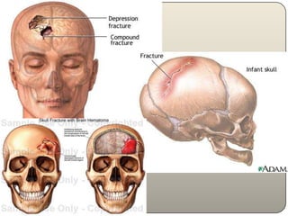 First DegreeSecond DegreeCharred BodyThird Degree