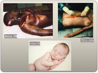 Burns  PMPM In  ActionInfant PM