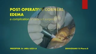 POST-OPERATIVE-CORNEAL
EDEMA
a complication of cataract surgery
PRECEPTOR: Dr (MRS) UZZI I.A OKHUOSAMI F.S Pharm.D
 