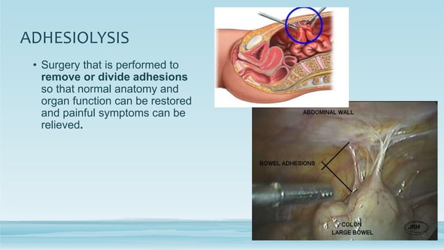 Post operative adhesions and management | PPTX | Death, Injury, or ...