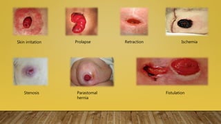 Skin irritation Prolapse Retraction Ischemia
Stenosis Parastomal
hernia
Fistulation
 