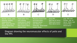 Diagram showing the neuromuscular effects of polio and
the PPS
Normal motor units
showing healthy
motorneurons,
their axons and the
muscle fibres they
innervate
Initial polio virus
with varying
motorneuron death
and denervation of
their muscle fibres
(dotted line)
Recovery-Axons from
surviving motor
neurons sprout
new fibres to
innervate denervated
muscle fibres
Early PPS
New loss of nerve
fibres and muscle
fibre denervation
Late PPS with
further loss of
nerve fibres and
muscle fibre
denervation
 