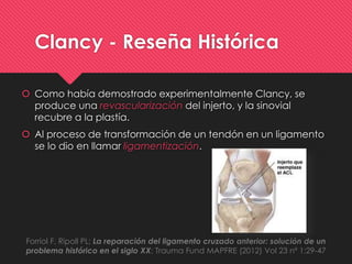  Como había demostrado experimentalmente Clancy, se
produce una revascularización del injerto, y la sinovial
recubre a la plastía.
 Al proceso de transformación de un tendón en un ligamento
se lo dio en llamar ligamentización.
Forriol F, Ripoll PL; La reparación del ligamento cruzado anterior: solución de un
problema histórico en el siglo XX; Trauma Fund MAPFRE (2012) Vol 23 nº 1:29-47
Clancy - Reseña Histórica
 