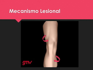 Mecanismo Lesional
 