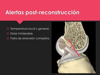 Alertas post-reconstrucción
 Temperatura local y general.
 Dolor intolerable.
 Falta de extensión completa.
 
