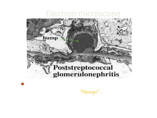 Electron microscope
Immune deposits on the epithelial side of glomerular
basement membrane form “Humps” .
 