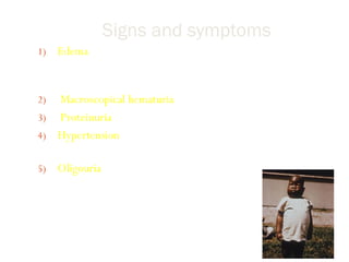 Signs and symptoms
1) Edema (90%) : typically found on face, periorbital and
upper extremities.acites and anasarca mayb occur in
children.
2) Macroscopical hematuria (65%) : meat-colored
3) Proteinuria : usual ,normalize after 4 weeks
4) Hypertension (75%) : mild- moderate , subside after
diuresis.
5) Oligouria : in children <0.5mL/day/hr
(minimum urine output 0.5 -1 mL/day/hr)
 