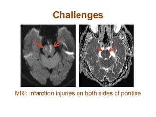Challenges
MRI: infarction injuries on both sides of pontine
 