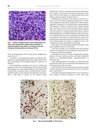 60                                            a p o l l o m e d i c i n e 1 0 ( 2 0 1 3 ) 5 7 e6 3



                                                                          Nondetection of EBV is associated with tumors that present
                                                                          late, usually are monoclonal, and are more resistant to treat-
                                                                          ment. They are more likely to be disseminated and are less
                                                                          likely to achieve complete remission (Fig. 2).
                                                                              Establishing the clonality of the lesion is important. Tu-
                                                                          mors can be monoclonal, oligoclonal, polyclonal, or mixed.
                                                                          Some lymphomas may appear polyclonal by surface immu-
                                                                          noglobulin staining but are monoclonal by immunoglobulin
                                                                          rearrangement. Reports of patients with multiple disease
                                                                          sites, one lesion of which was monoclonal while a distant
                                                                          lesion was polyclonal, have occurred. Monoclonal PTLD has
                                                                          a worse prognosis, so multiple biopsy sites may be useful in
                                                                          deﬁning prognosis in an individual with more than one lesion.
                                                                          Do not assume that if one site is polyclonal, all disease sites
                                                                          are polyclonal. PTLD does not demonstrate the 8:14 or 8:22
                                                                          translocations associated with Burkitt lymphoma. PTLD can-
                                                                          not be differentiated into benign or malignant tumors. The
Fig. 1 e Biopsy of gingival tissue, with haematoxylin and                 mortality rate is high, independent of histology.
eosin stain demonstrates polymorphous inﬁltrate of                            With regard to T-cell lymphoproliferative disorders, these
atypical lymphoid cells, which is consistent with post-                   lesions predominantly are monoclonal.
transplant lymphoproliferative disease (PTLD).                                T-cell PTLD usually is not associated with EBV infection
                                                                          and does not respond to immunosuppression dose reduction.
                                                                          It carries an unfavorable prognosis.
PTLD, (3) monomorphic PTLD, and (4) classic Hodgkin lym-                      Radiological evaluation includes computerized tomogra-
phoma (Fig. 1).10                                                         phy scan of chest, abdomen, pelvis, and head, looking for
   In practice, a clear separation between the different sub-             evidence of hepatosplenomegaly, lymphadenopathy, or
types is not always possible; early lesions, polymorphic PTLD,            abnormal mass.
and monomorphic PTLD probably represent a spectrum of                         T-cell lymphoproliferative disorders not associated with
diseases.11                                                               EBV infection tend to occur at extranodal sites. Reports exist of
   Immunohistologic staining can be used to conﬁrm the                    PTLD presenting in the oral cavity.
presence of EBV. In situ hybridization with the EBV-encoded                   Gastrointestinal PTLD usually involves the small and large
RNA (EpsteineBarr early region [EBER]-1) probe (labels EBV-               intestine and most common presentation is fever, abdominal
encoded RNA in infected cells) is a reliable means of detect-             pain or perforation.12
ing EBV in tissue. It also requires demonstration of the pres-                It has been observed that gastric PTLD is more common in
ence of EBV DNA or protein in the biopsied tissue.                        renal allograft recipients compared to other solid organ




                                        Fig. 2 e EBV early RNA (EBER) in PTLD tissue.
 