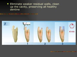Eliminate weaker residual walls, clean up the cavity, preserving all healthy dentine 
