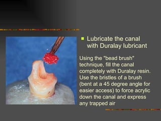 Lubricate the canal with Duralay lubricant Using the "bead brush" technique, fill the canal completely with Duralay resin. Use the bristles of a brush (bent at a 45 degree angle for easier access) to force acrylic down the canal and express any trapped air 
