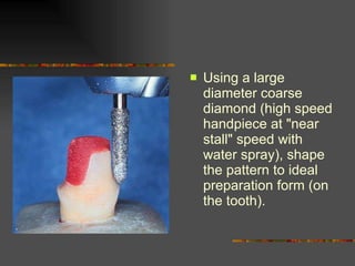 Using a large diameter coarse diamond (high speed handpiece at "near stall" speed with water spray), shape the pattern to ideal preparation form (on the tooth).  