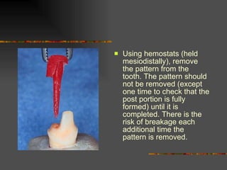 Using hemostats (held mesiodistally), remove the pattern from the tooth. The pattern should not be removed (except one time to check that the post portion is fully formed) until it is completed. There is the risk of breakage each additional time the pattern is removed. 