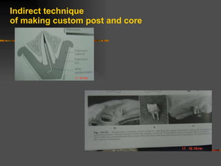 Indirect technique of making custom post and core 