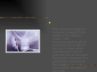   The minimum length of the post is equal to the length of the clinical crown. The recommended length is two-thirds the length of the root in bone while maintaining 5 mm of gutta-percha at the apex. Remember chances of a perforation increase as the length of the post approaches the apex of the tooth. 