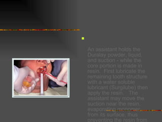   An assistant holds the Duralay powder, liquid, and suction - while the core portion is made in resin.  First lubricate the remaining tooth structure with a water soluble lubricant (Surgilube) then apply the resin.   The assistant may move the suction near the resin, evaporating monomer from its surface, thus preventing the resin from slumping or running. 