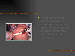 Using conventional diamond instruments, water and suction, the resin core is prepared in the same manner as a conventional preparation   