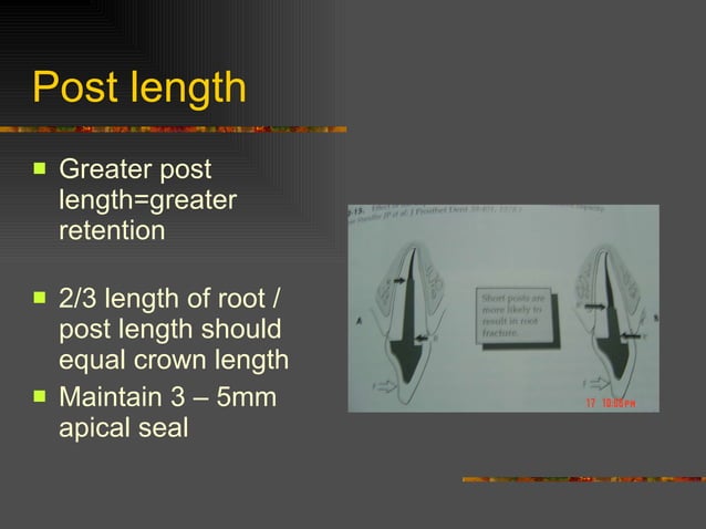 Post and core | PPT | Oral care | Personal Care