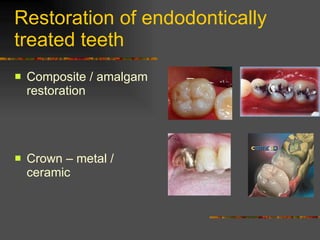 Restoration of endodontically treated teeth ,[object Object],[object Object]