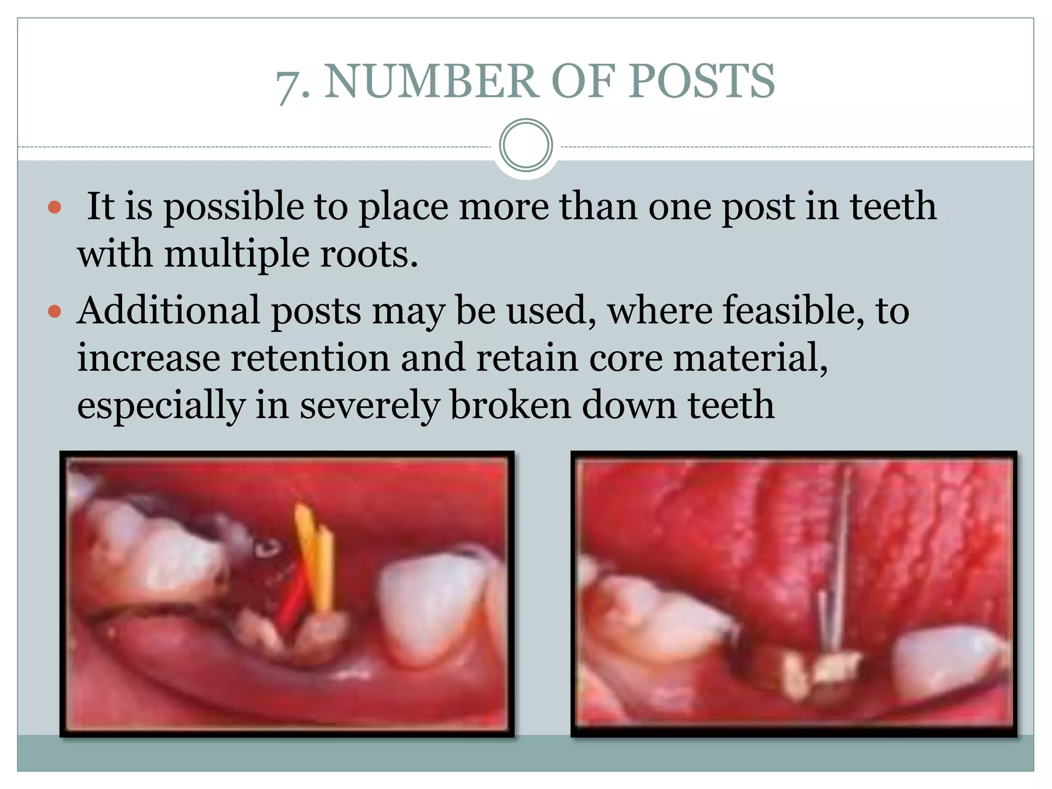7. NUMBER OF POSTS
 It is possible to place more than one post in teeth
with multiple roots.
 Additional posts may be used, where feasible, to
increase retention and retain core material,
especially in severely broken down teeth
 