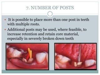 Post End Core Post and core | PPTX