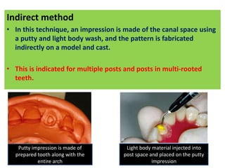 Post Indirect Kit post and core.pptx