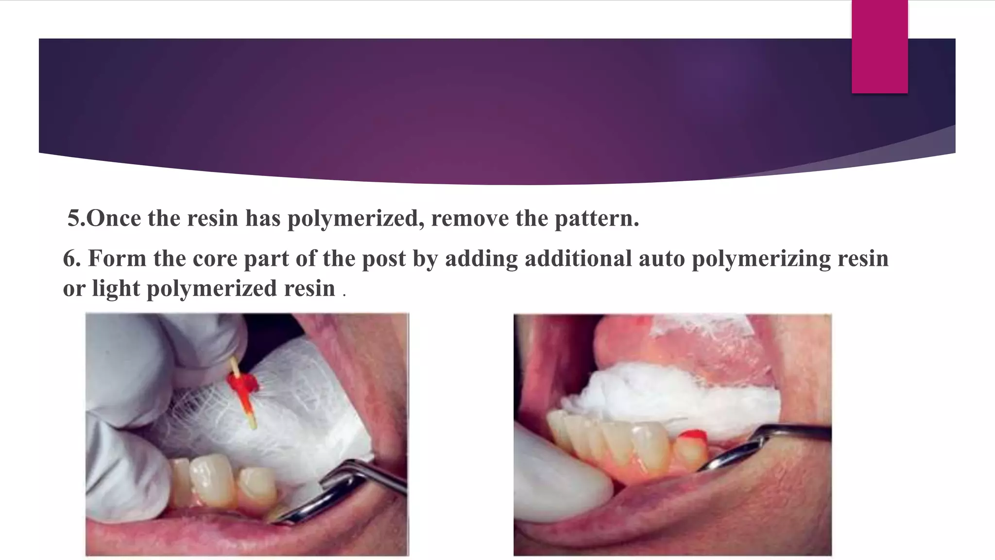 post and core.pptx