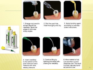 post and core implications in prosthodontics | PPTX