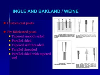 Pre Tapped Posts POST AND CORE (2).ppt