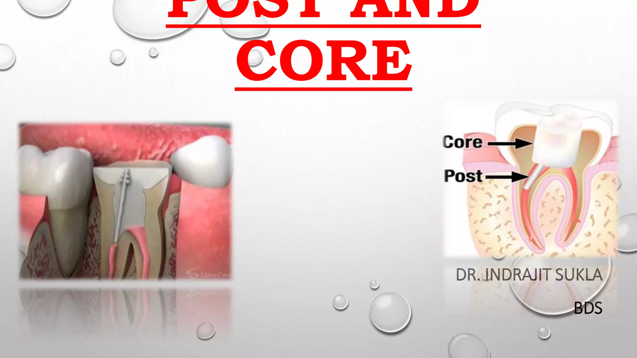 Post and core short by Dr.Soumya Ranjan | PPTX