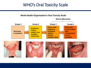 WHO’s Oral Toxicity Scale
Soreness
± erythema
Erythema,
ulcers;
patient can
swallow
solid food
Mucositis
to the extent
that
alimentation
is not
possible
Ulcers with
extensive
erythema;
patient
cannot
swallow food
Grade 2 Grade 3
Severe Mucositis
Grade 1 Grade 4
World Health Organization’s Oral Toxicity Scale
 