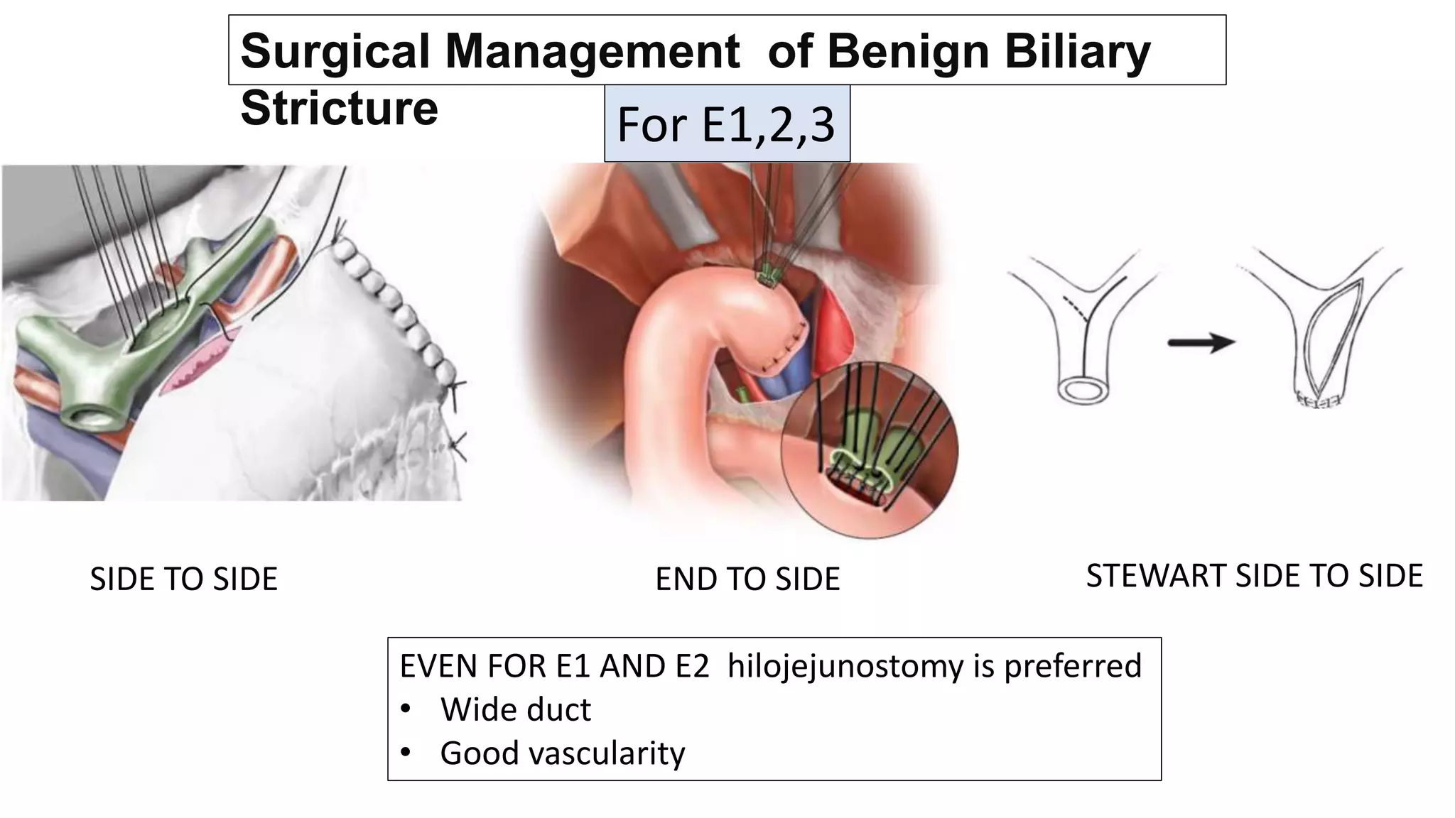 Bile duct injury.pptx - Evaluation Of Bile Duct Injury After Surgery