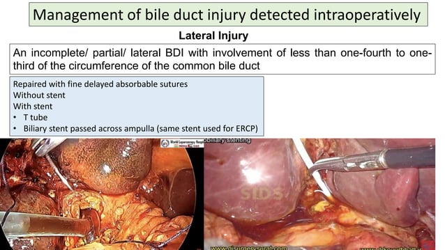 A closer look at Evaluation Of Bile Duct Injury After Surgery