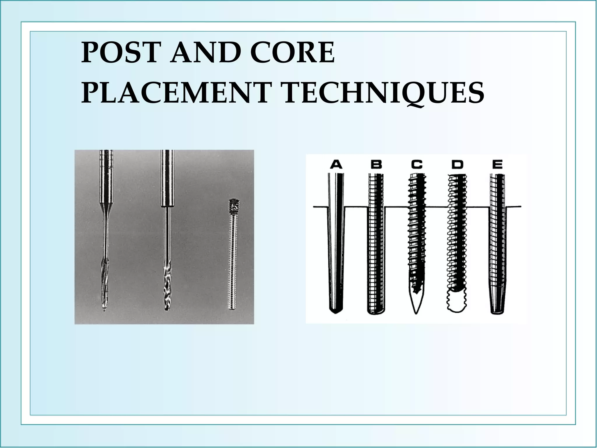 POST AND CORE PLACEMENT TECHNIQUES 