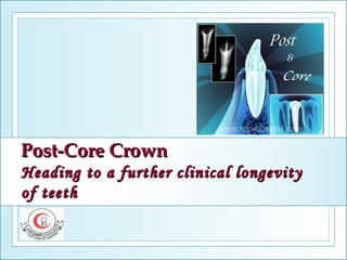 Post-Core Crown Heading to a further clinical longevity of teeth 