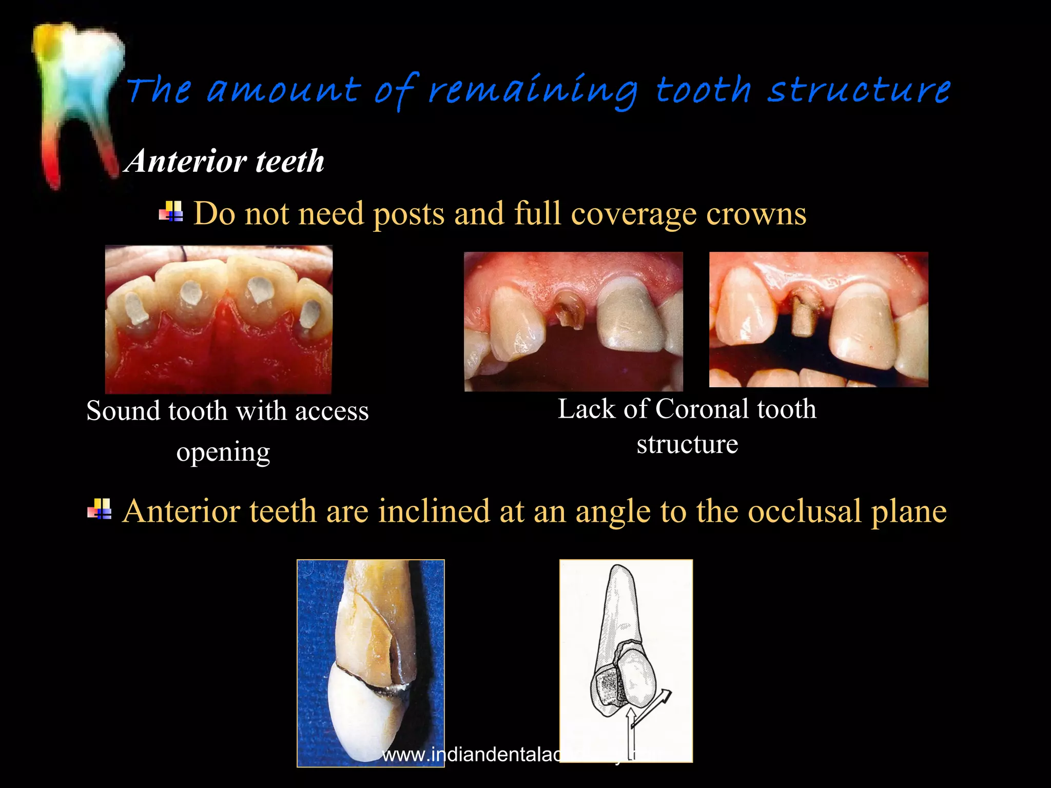 The amount of remaining tooth structure
Anterior teeth
Do not need posts and full coverage crowns

Sound tooth with access
opening

Lack of Coronal tooth
structure

Anterior teeth are inclined at an angle to the occlusal plane

www.indiandentalacademy.com

 