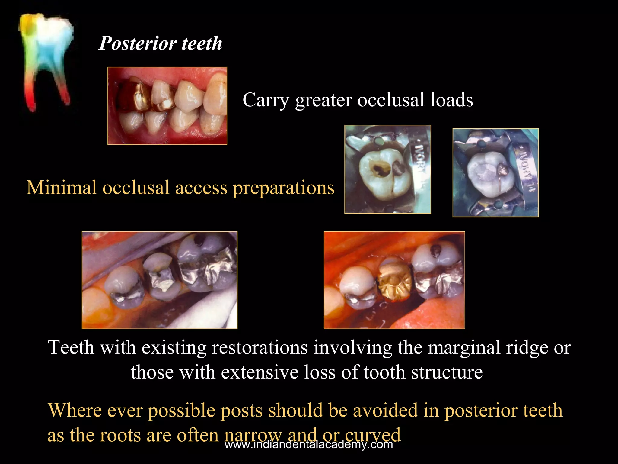 Posterior teeth
Carry greater occlusal loads

Minimal occlusal access preparations

Teeth with existing restorations involving the marginal ridge or
those with extensive loss of tooth structure
Where ever possible posts should be avoided in posterior teeth
as the roots are often narrow and or curved
www.indiandentalacademy.com

 