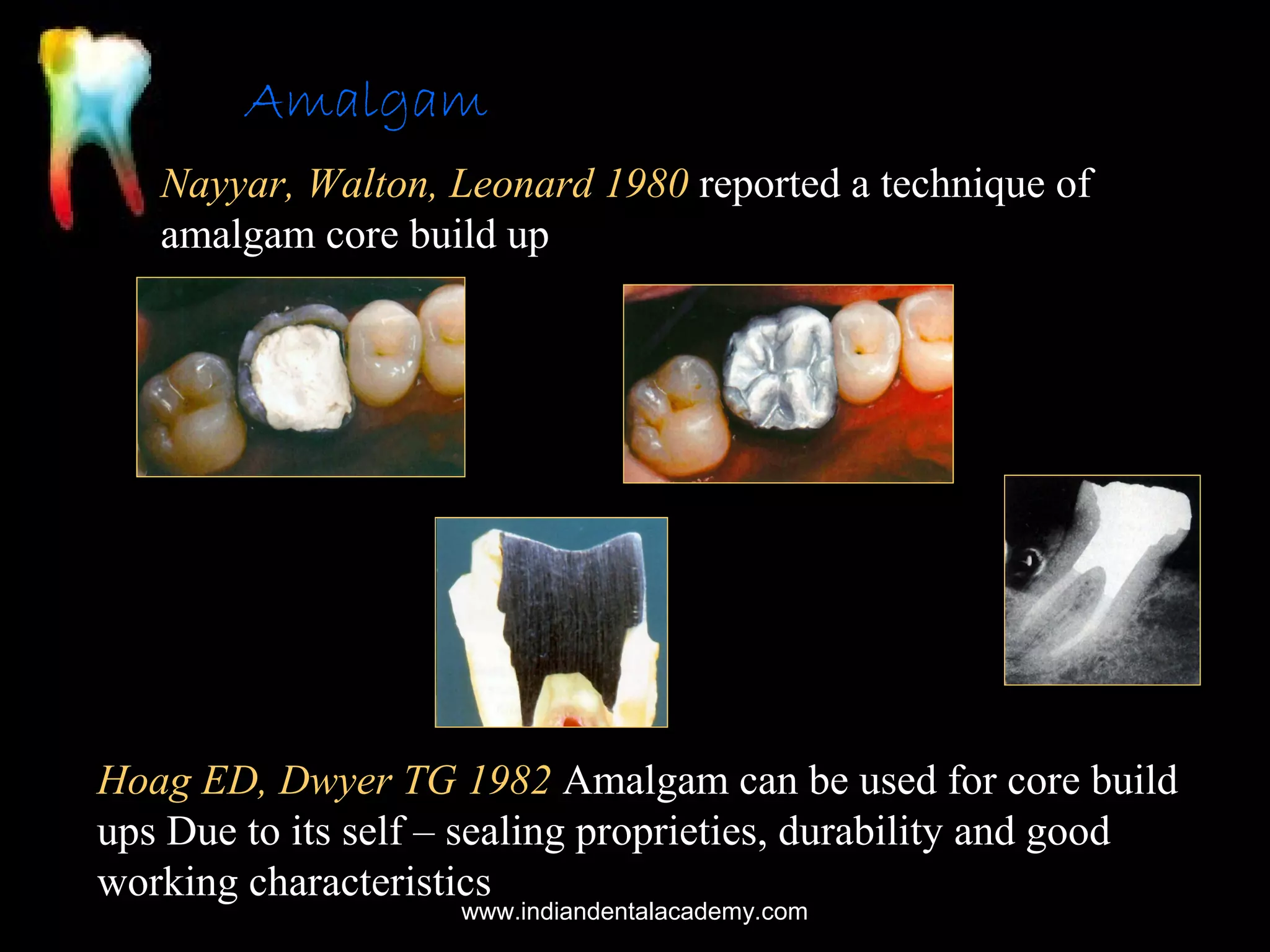 Amalgam
Nayyar, Walton, Leonard 1980 reported a technique of
amalgam core build up

Hoag ED, Dwyer TG 1982 Amalgam can be used for core build
ups Due to its self – sealing proprieties, durability and good
working characteristics
www.indiandentalacademy.com

 